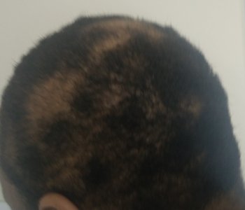 A photo of the back of my head showing some of the bold patches cause by my hair destroying behaviours