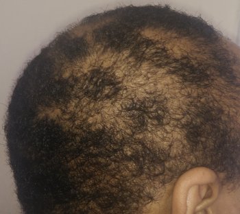 another photo of the back and right side of my head to show the damage caused by my hair pulling and other hair damaging behaviours