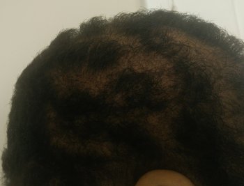 A photo of the right side of my head showing the damage caused by my hair destroying behaviours