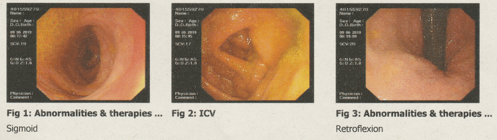 Another three images taken during my Gastroscopy and Colonoscopy exam to represent the topic of the article - An Account Of The Gastroscopy, Colonoscopy, And Its Preparations