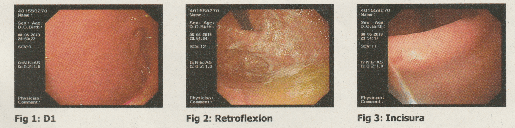 Three images taken during my gastroscopy
