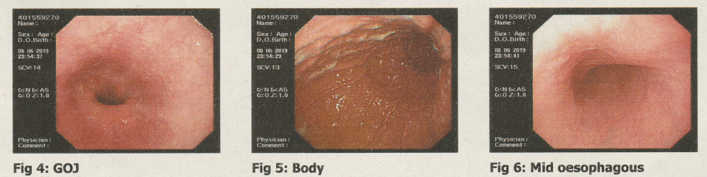 Three images taken during my colonoscopy to represent the topic of the article - An Account Of The Gastroscopy, Colonoscopy, And Its Preparations