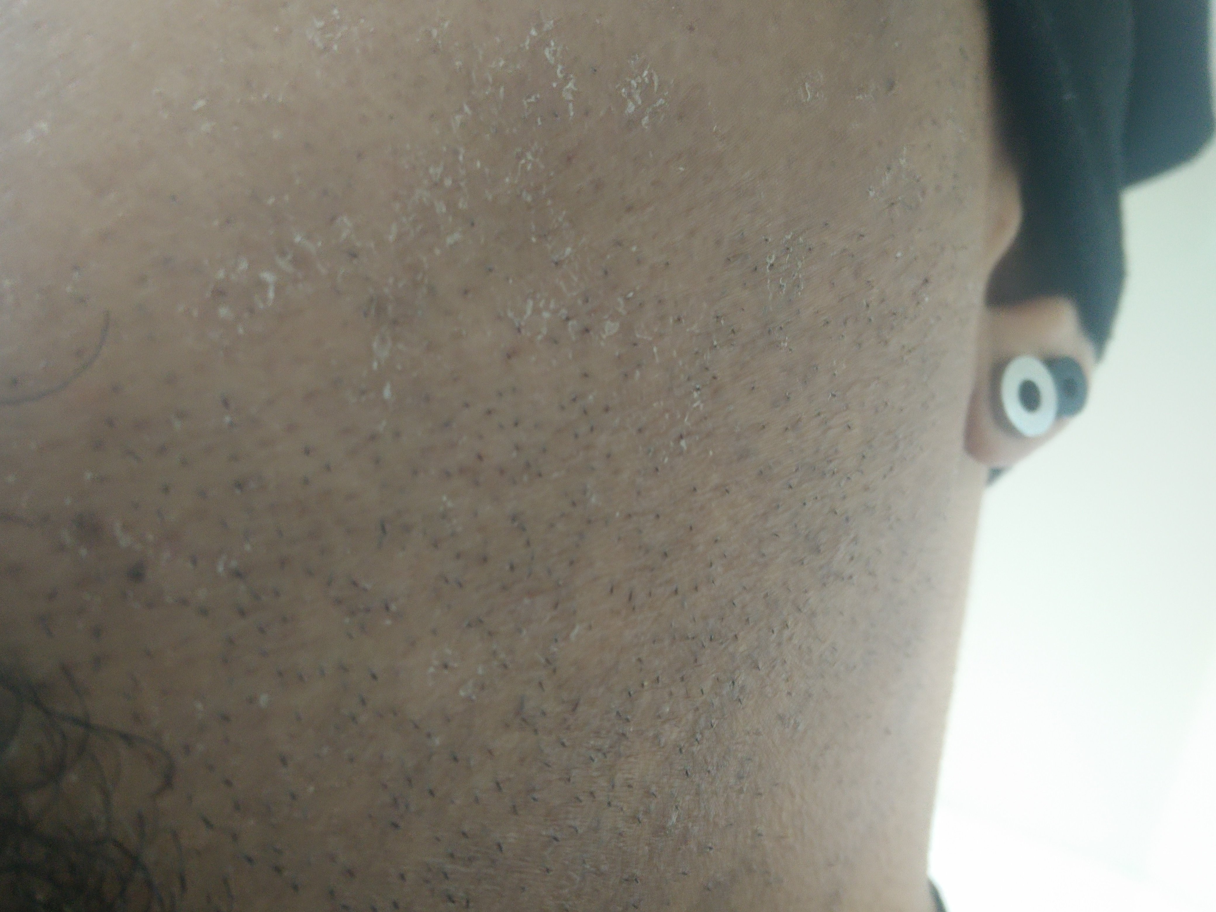 A photo of my dry skin after using La Roche-Posay’s Effaclar Duo (+) to represent the topic of the article - A Moisturiser Review: Complex Skin And Mental Health