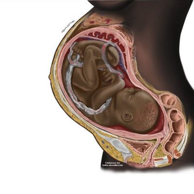 Chidiebere Sunday Ibe drawing of a Black foetus and mother to represent the topic of the article - Black Health And Wellness: Racism In The Medical Field